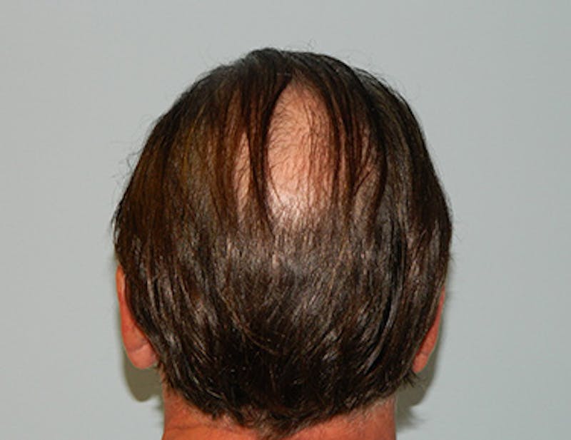 Hair Transplant (Smartgraft) Before & After Gallery - Patient 133066246 - Image 3