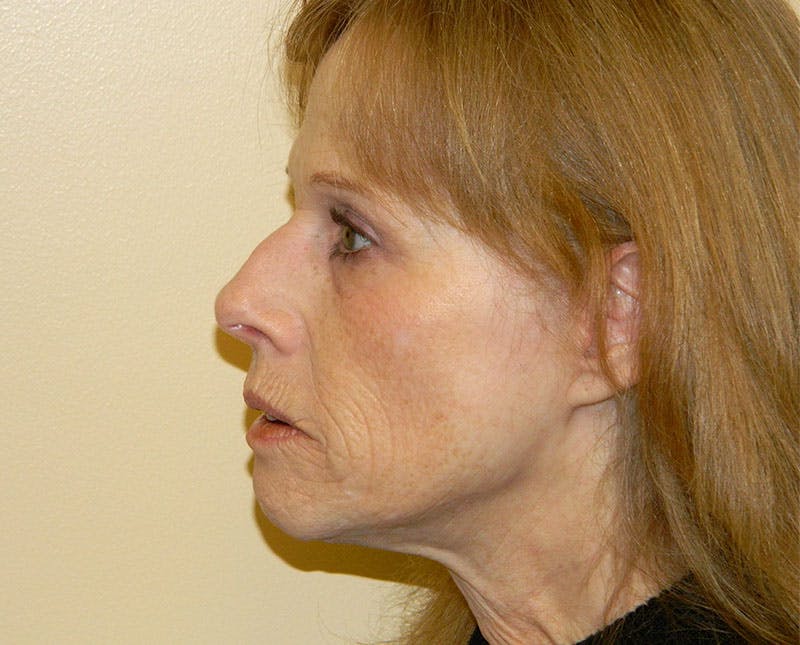 Mini-Facelift Before & After Gallery - Patient 133066247 - Image 5