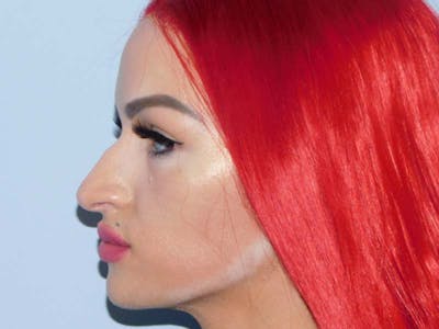 Rhinoplasty Before & After Gallery - Patient 133066252 - Image 1