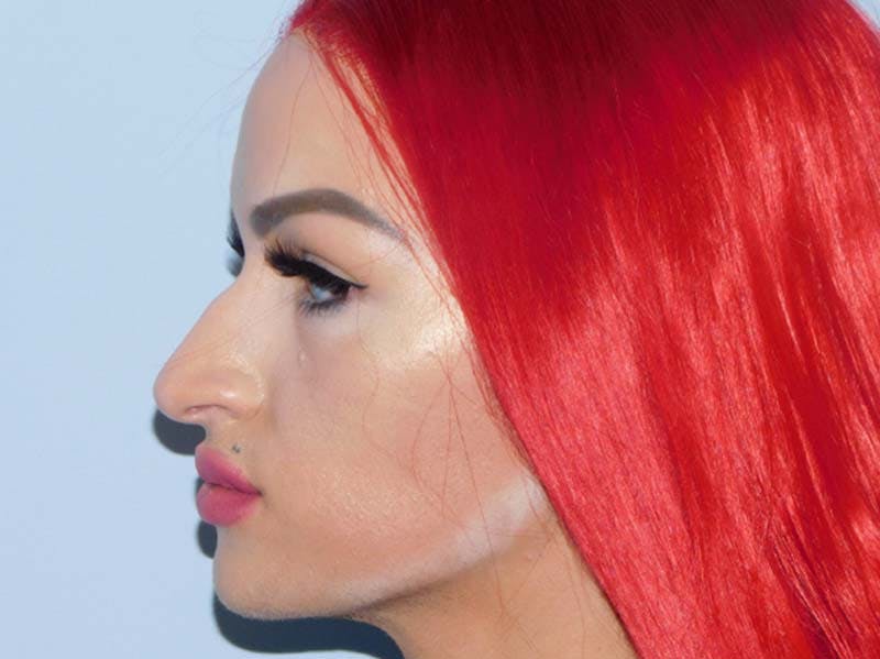 Rhinoplasty Before & After Gallery - Patient 133066252 - Image 1