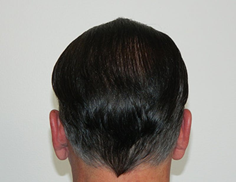 Hair Transplant (Smartgraft) Before & After Gallery - Patient 133066246 - Image 4