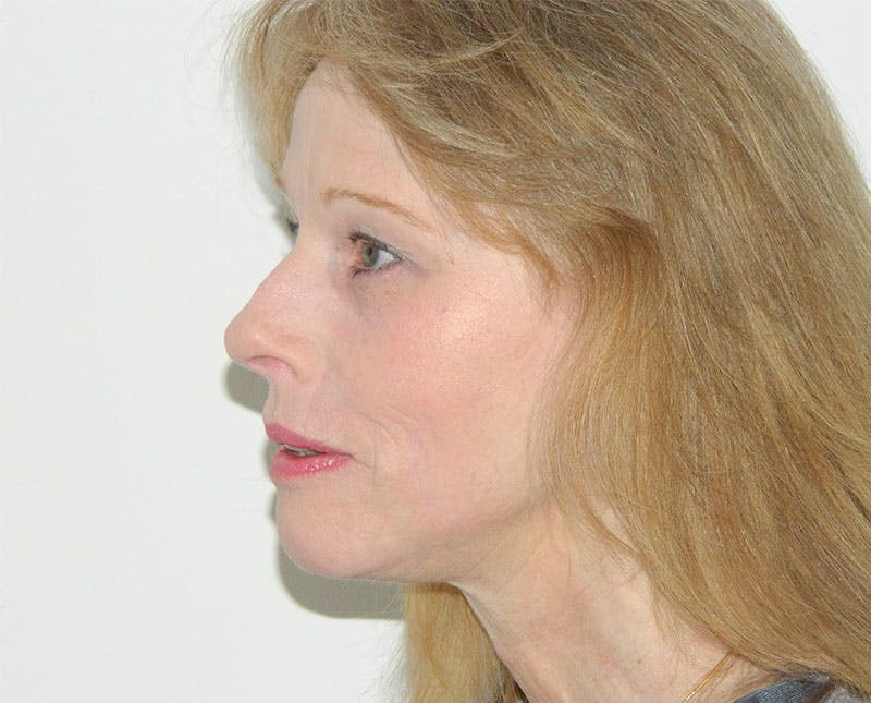 Mini-Facelift Before & After Gallery - Patient 133066247 - Image 6