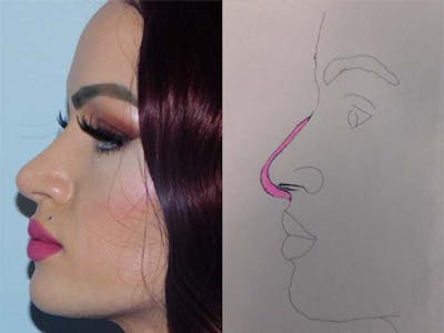 Rhinoplasty Before & After Gallery - Patient 133066252 - Image 2
