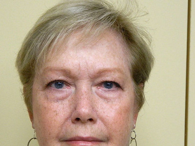 Brow Lift Before & After Gallery - Patient 133066248 - Image 1