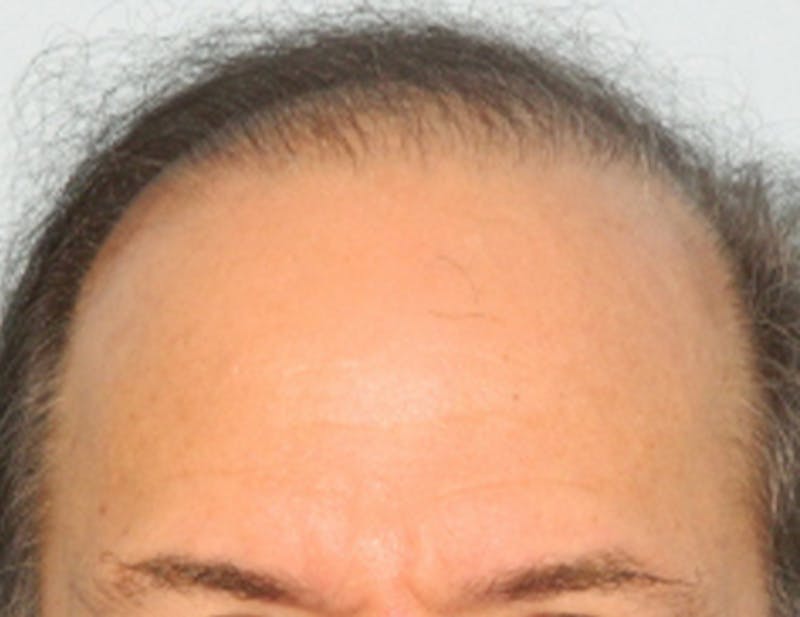 Hair Transplant (Smartgraft) Before & After Gallery - Patient 133066249 - Image 1