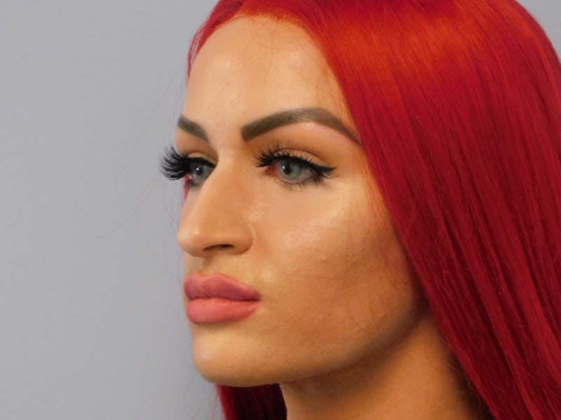 Rhinoplasty Before & After Gallery - Patient 133066252 - Image 3