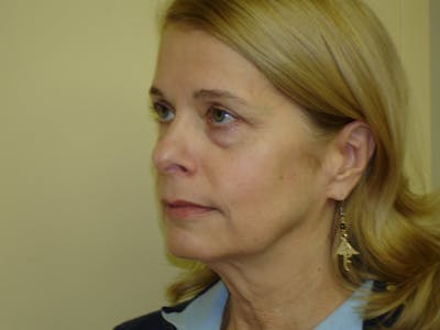 Mini-Facelift Before & After Gallery - Patient 133066262 - Image 1
