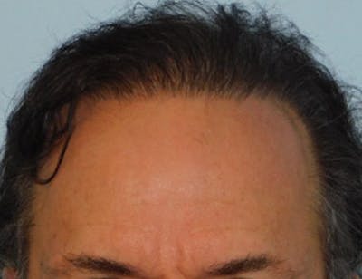 Hair Transplant (Smartgraft) Before & After Gallery - Patient 133066249 - Image 2