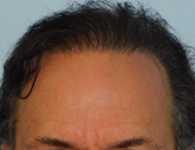 Hair Transplant (Smartgraft) Before & After Gallery - Patient 133066249 - Image 2