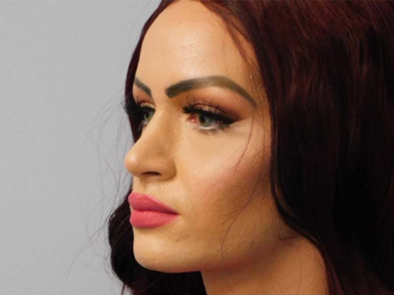 Rhinoplasty Before & After Gallery - Patient 133066252 - Image 4