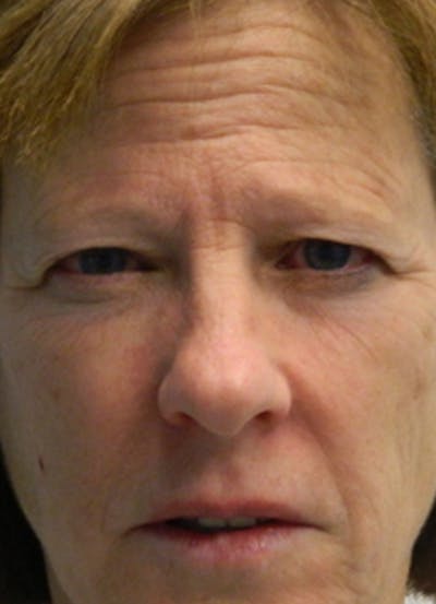 Brow Lift Before & After Gallery - Patient 133066250 - Image 1