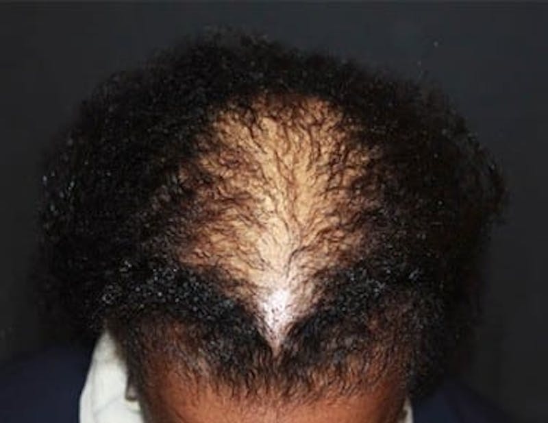 Hair Transplant (Smartgraft) Before & After Gallery - Patient 133066251 - Image 1