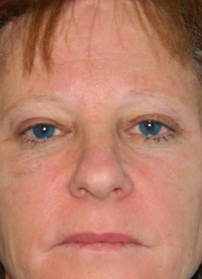 Brow Lift Before & After Gallery - Patient 133066250 - Image 2