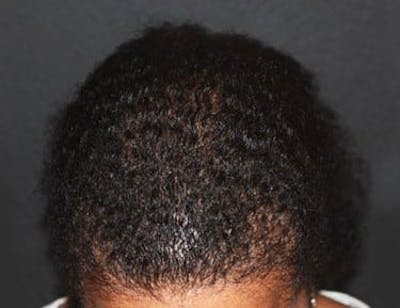 Hair Transplant (Smartgraft) Before & After Gallery - Patient 133066251 - Image 2