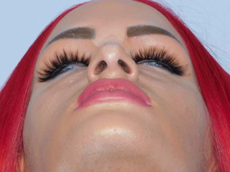 Rhinoplasty Before & After Gallery - Patient 133066252 - Image 7