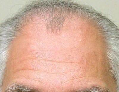 Hair Transplant (Smartgraft) Before & After Gallery - Patient 133066253 - Image 1