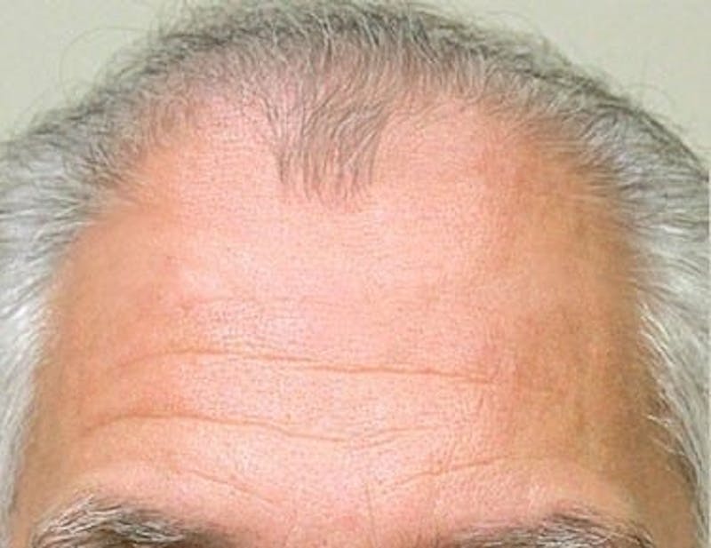 Hair Transplant (Smartgraft) Before & After Gallery - Patient 133066253 - Image 1