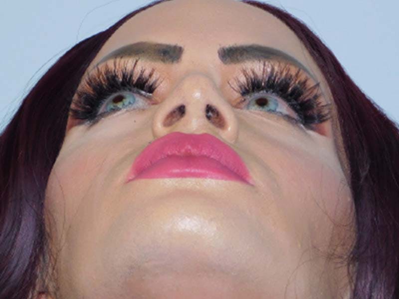 Rhinoplasty Before & After Gallery - Patient 133066252 - Image 8