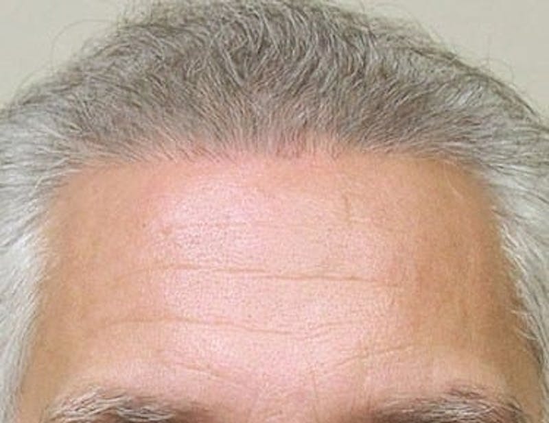 Hair Transplant (Smartgraft) Before & After Gallery - Patient 133066253 - Image 2