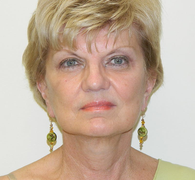 Brow Lift Before & After Gallery - Patient 133066260 - Image 2