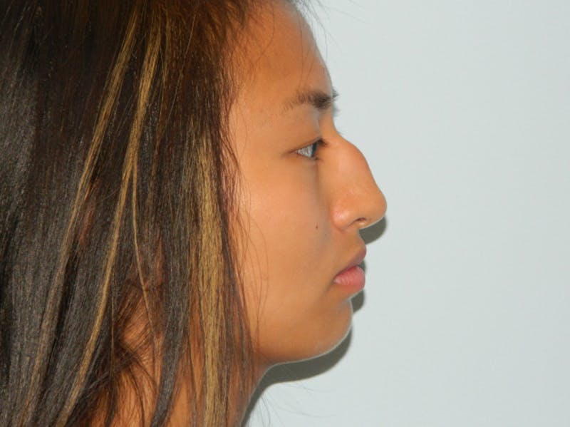 Rhinoplasty Before & After Gallery - Patient 133066267 - Image 1