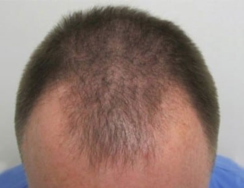 Hair Transplant (Smartgraft) Before & After Gallery - Patient 133066255 - Image 1