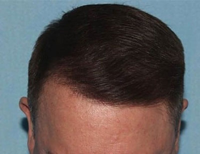 Hair Transplant (Smartgraft) Before & After Gallery - Patient 133066255 - Image 2
