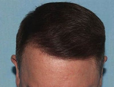 Hair Transplant (Smartgraft) Before & After Gallery - Patient 133066255 - Image 2
