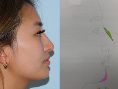 Rhinoplasty Before & After Gallery - Patient 133066267 - Image 2