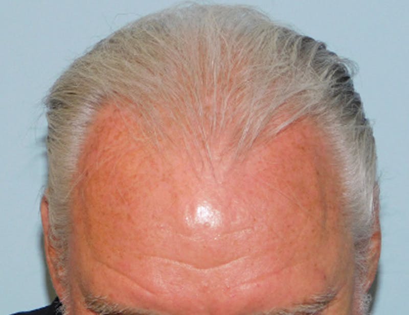 Hair Transplant (Smartgraft) Before & After Gallery - Patient 133066261 - Image 1