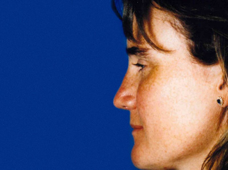 Chin Reduction Before & After Gallery - Patient 133066256 - Image 2