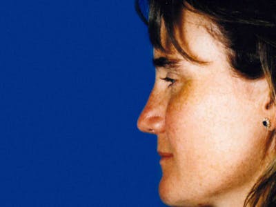 Chin Reduction Before & After Gallery - Patient 133066256 - Image 2