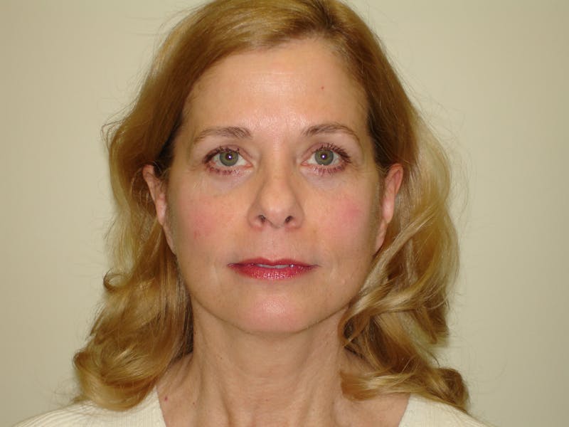 Mini-Facelift Before & After Gallery - Patient 133066262 - Image 4