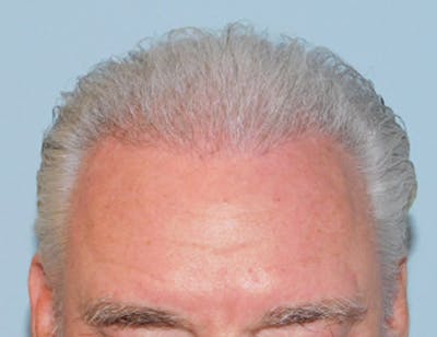 Hair Transplant (Smartgraft) Before & After Gallery - Patient 133066261 - Image 2