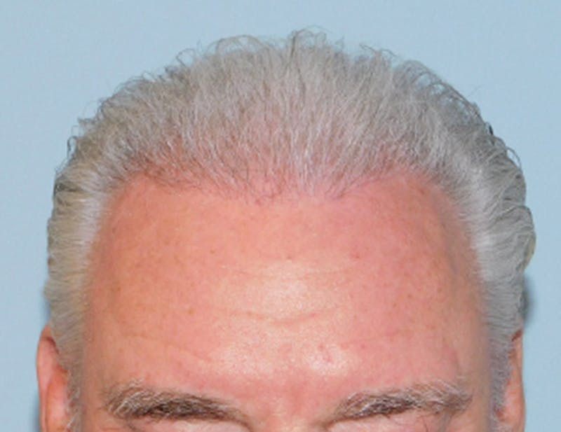 Hair Transplant (Smartgraft) Before & After Gallery - Patient 133066261 - Image 2