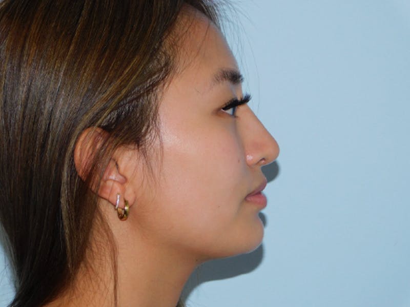Rhinoplasty Before & After Gallery - Patient 133066267 - Image 4