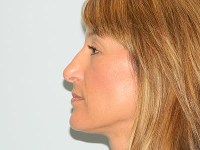 Chin Reduction Before & After Gallery - Patient 133066268 - Image 1