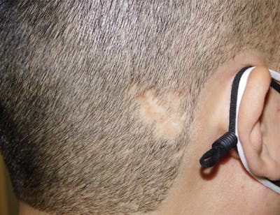 Hair Transplant (Smartgraft) Before & After Gallery - Patient 133066265 - Image 1