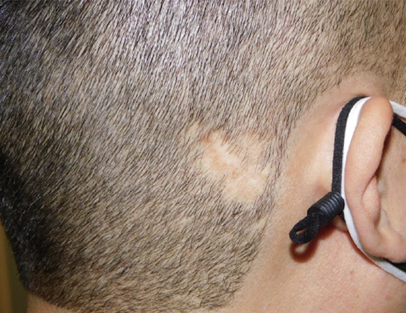 Hair Transplant (Smartgraft) Before & After Gallery - Patient 133066265 - Image 1