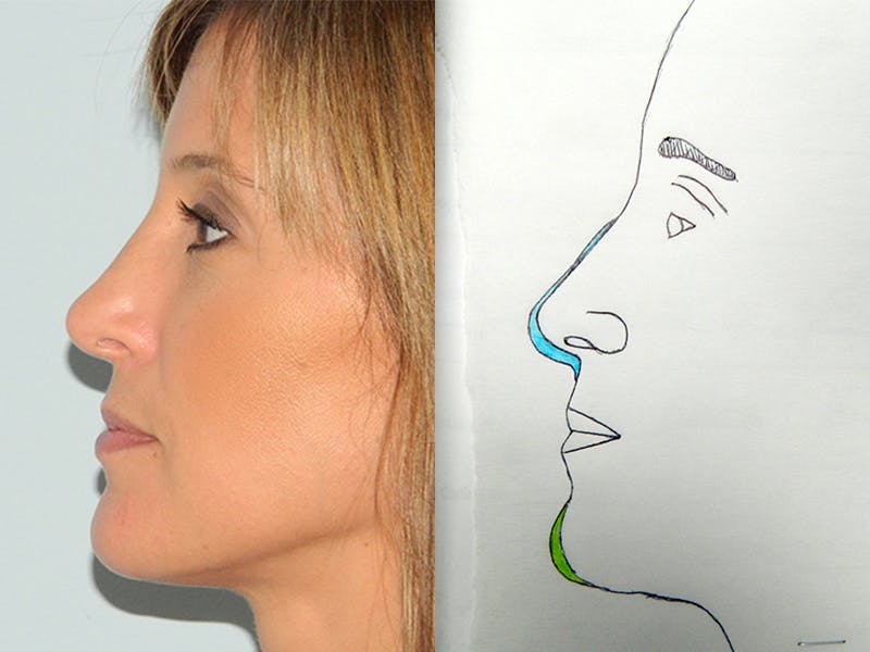 Chin Reduction Before & After Gallery - Patient 133066268 - Image 2