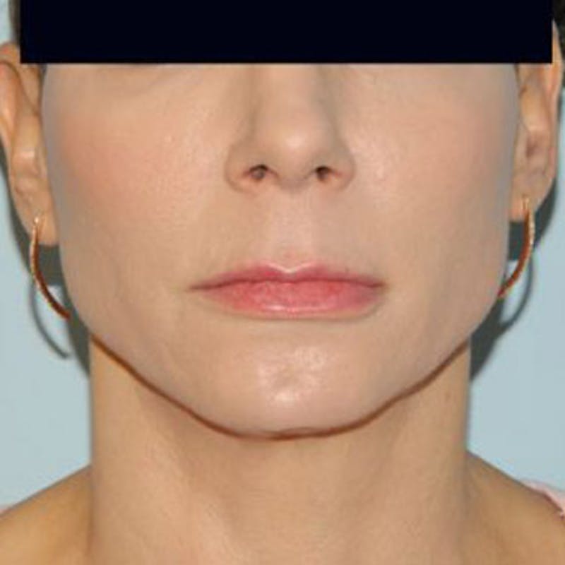 Lip Lift & Augmentation Before & After Gallery - Patient 133066264 - Image 1