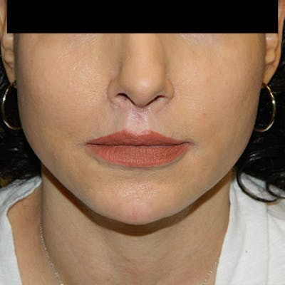 Lip Lift & Augmentation Before & After Gallery - Patient 133066264 - Image 2