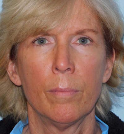Mini-Facelift Before & After Gallery - Patient 133066271 - Image 1