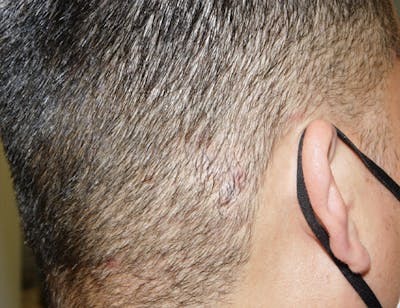 Hair Transplant (Smartgraft) Before & After Gallery - Patient 133066265 - Image 2