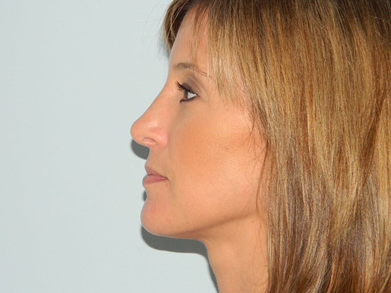 Chin Reduction Before & After Gallery - Patient 133066268 - Image 4