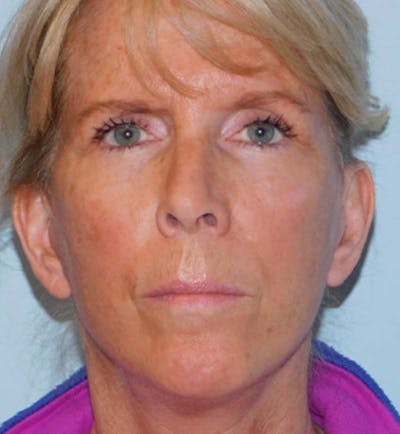 Mini-Facelift Before & After Gallery - Patient 133066271 - Image 2