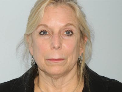 Lip Lift & Augmentation Before & After Gallery - Patient 133066270 - Image 1