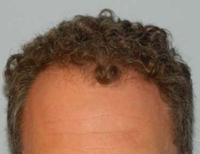 Hair Transplant (Smartgraft) Before & After Gallery - Patient 133066266 - Image 1
