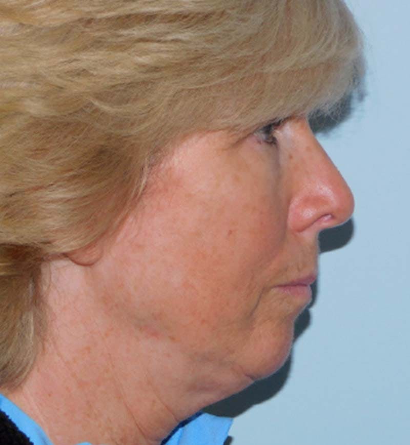 Mini-Facelift Before & After Gallery - Patient 133066271 - Image 3