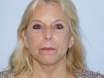 Lip Lift & Augmentation Before & After Gallery - Patient 133066270 - Image 2
